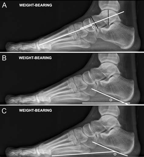 Adult Acquired Flatfoot Deformity: Anatomy, Biomechanics, Staging, and ...
