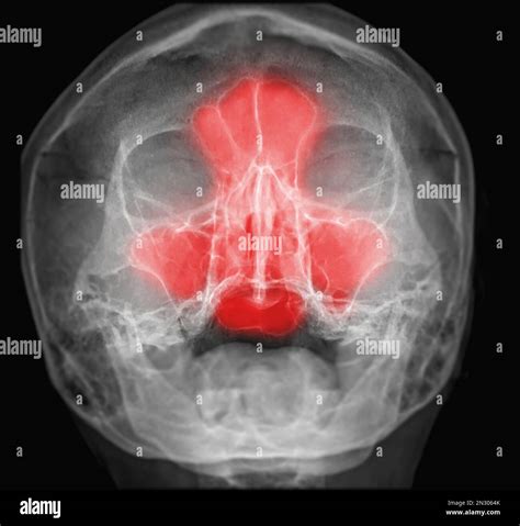x-ray image of paranasal sinuses for diagnosis sinusitis Stock Photo ...
