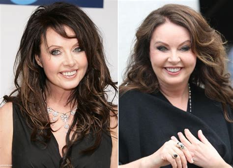 Less is more-Attack of the Pillow Face | Face fillers, Injectables fillers, Celebrities