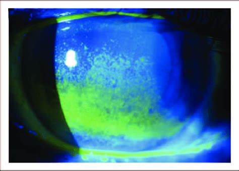 Fluorescein Sodium Strips And Fluorescein Angiography Eye, 46% OFF