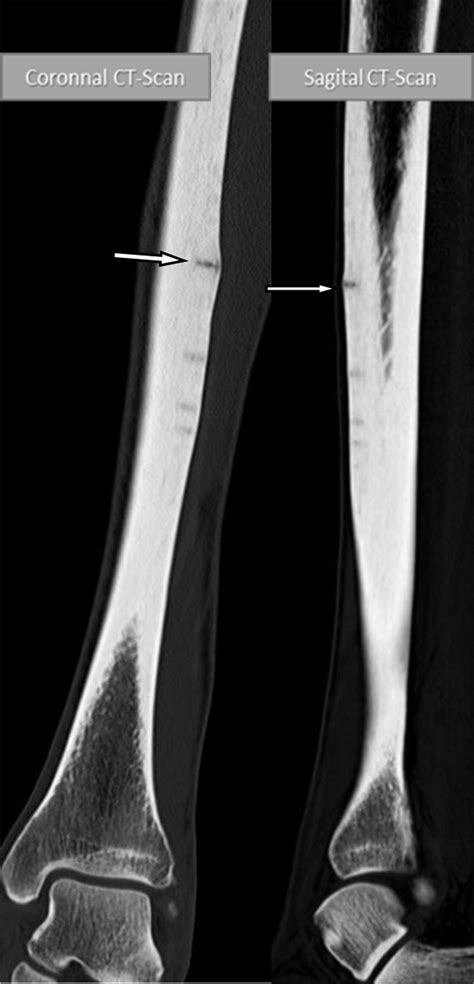 Stress Fracture Tibia Bone Scan
