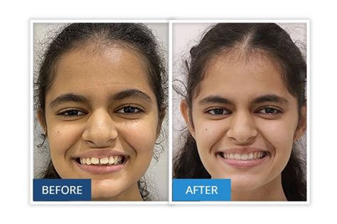 Invisalign in Gurgaon | Invisible Braces Treatment Cost in Gurgaon
