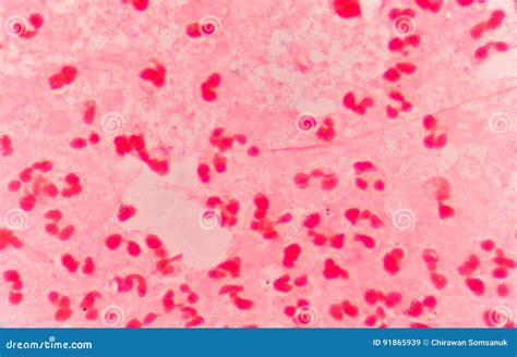 Moderate Red White Blood Cells with Gram Negative Diplococci. Stock ...
