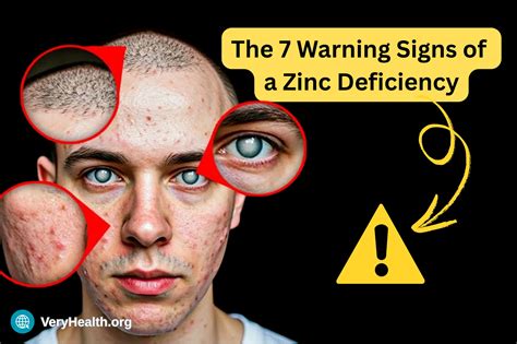 7 Zinc Deficiency SIGNS To Know and How To Prevent Them - VeryHealth