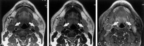 Kuvatulokset haulle pericolonic lymph nodes