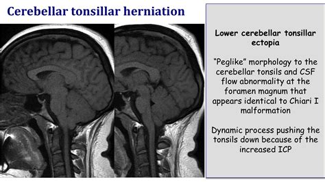 Tonsils Of Cerebellum