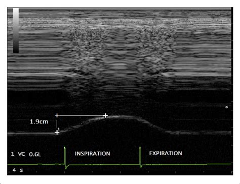 Image result for Excursion Lungs