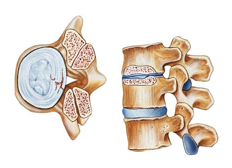 What Is Lateral Recess Stenosis and How Is It Treated?