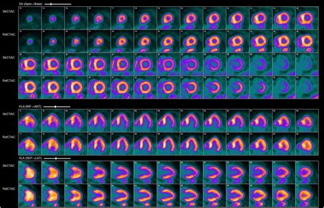 Transient ischemic dilatation in cardiac amyloidosis - Journal of Nuclear Cardiology