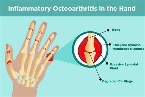 Hand Osteoarthritis Is Worse When It Affects Your Fingers and Base of Thumb