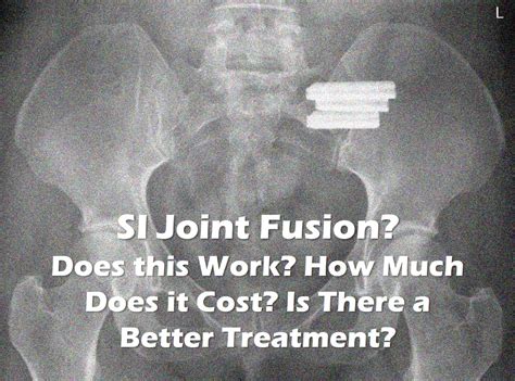 SI Joint Fusion: Does This Work? | Regenexx Blog