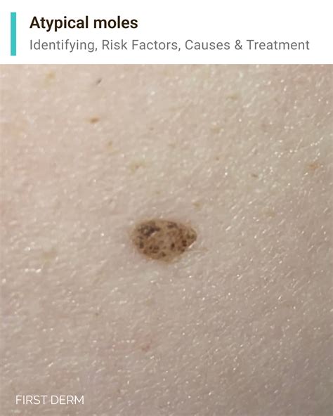 Best 11 Atypical Moles – Artofit