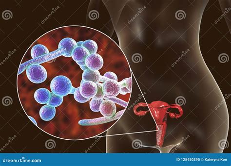 Vaginal Thrush, Female Candidiasis Stock Illustration - Illustration of ...