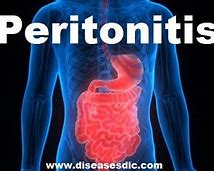 peritonitis 的图像结果