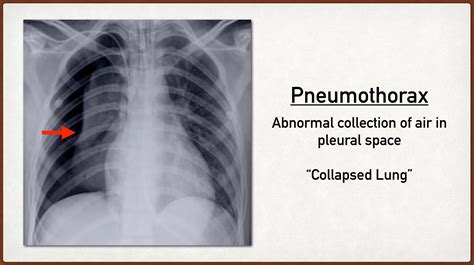Open Pneumothorax X Ray Pneumothorax Physiopedia
