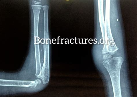 Non-displaced fracture of the lateral condyle in children.