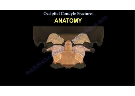 Occipital Condyle Fracture