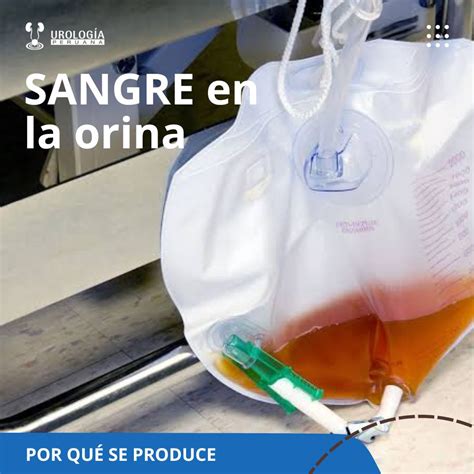 Sangre en la orina - Urología Peruana. Dr. Susaníbar