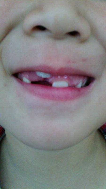 8岁小孩竟长出畸形双排牙，牙医：都是父母的错！|粗纤维食物|双排|牙医_新浪新闻