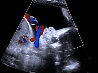 Bildergebnis für umbilical cord wrapped around neck