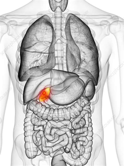 Image result for Gallbladder Cancer