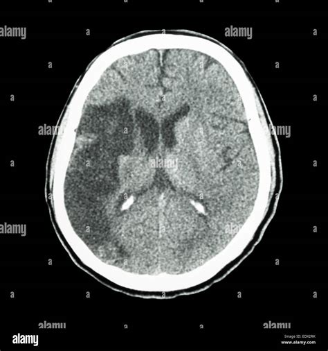 CT brain : show Ischemic stroke (hypodensity at right frontal-parietal ...