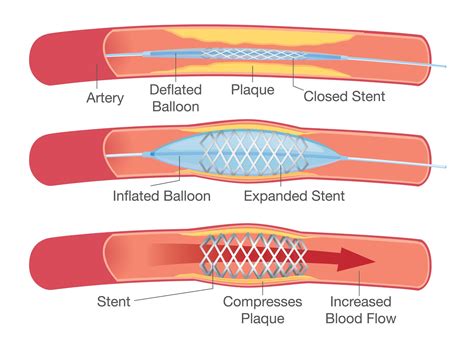 Stents In Arteries Legs
