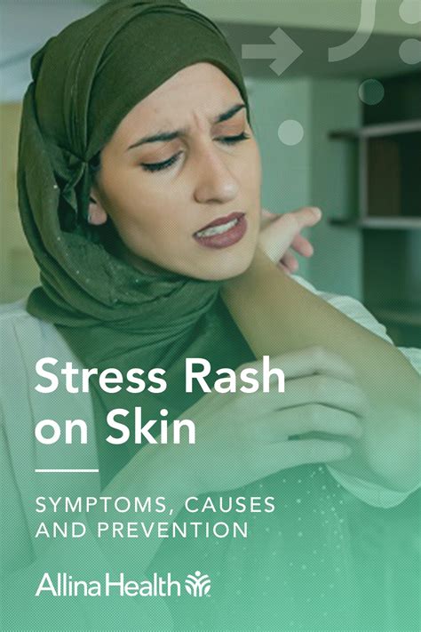 Stress rash causes symptoms and treatment – Artofit