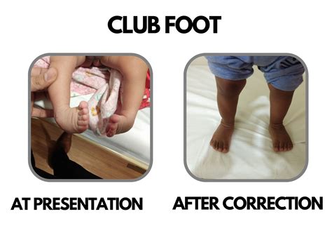 Club Foot Treatment