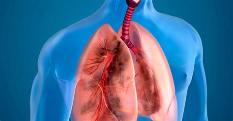 Best Pulmonologist in Mumbai | Dr Sanjeev Mehta