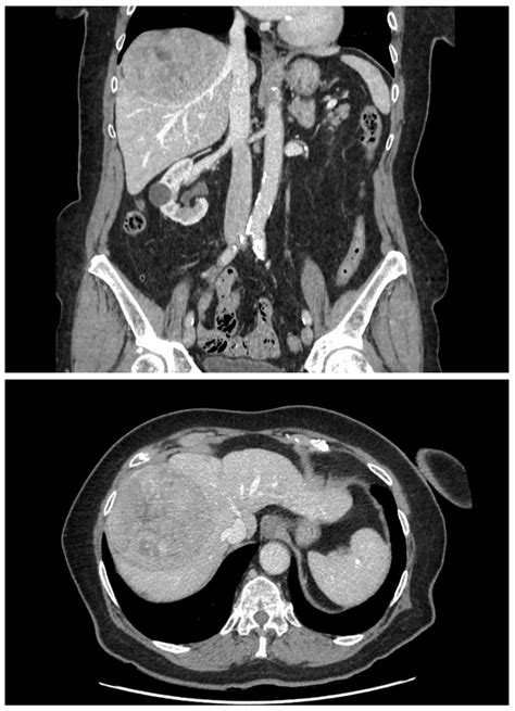 A Rare Early-Onset Fatal Complication after Transarterial ...