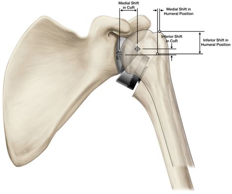 Reverse Shoulder Arthroplasty Biomechanics