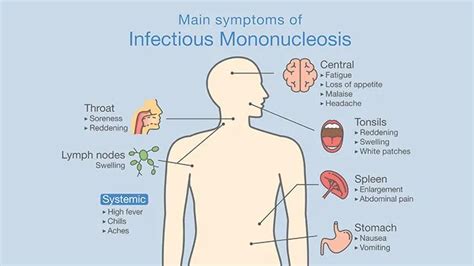 Symptoms of Mononucleosis