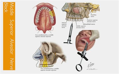 Maxillary Local Anesthesia 的图像结果