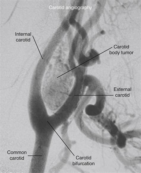Carotid Body Tumors - Clinical Tree