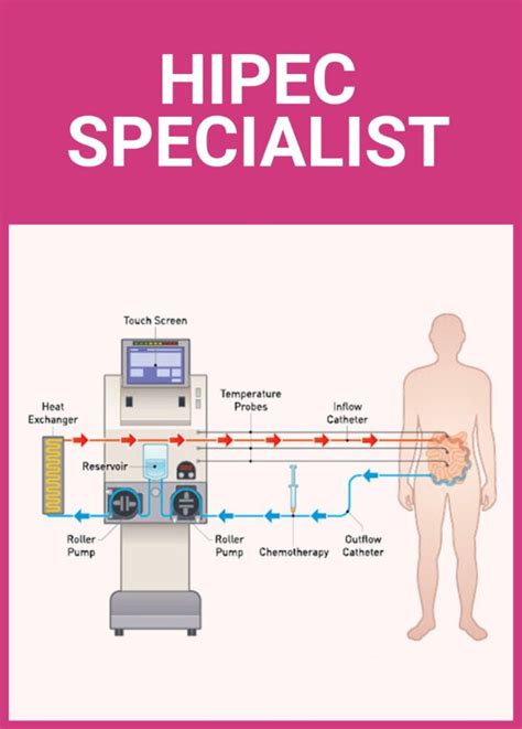 Image result for HIPEC Surgery for Appendix Cancer