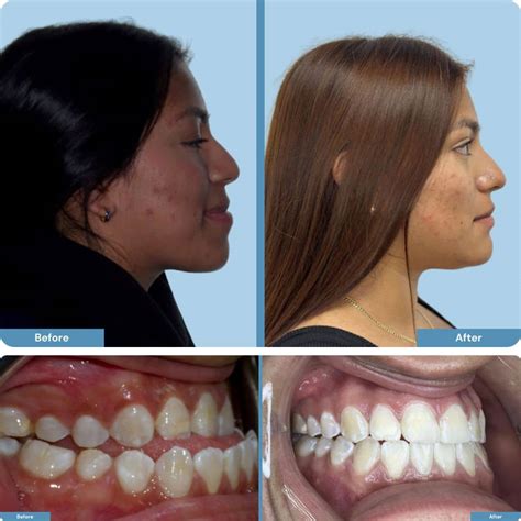 Orthognathic Jaw Surgery | Staten Island Oral Surgery