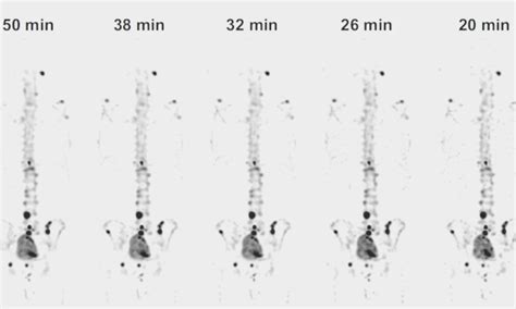 Whole-body SPECT/CT with CZT system significantly cuts scan time for ...