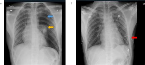 PRIMARY SPONTANEOUS PNEUMOTHORAX WITH AN APICAL BLEB: CONTROVERSIES IN ...