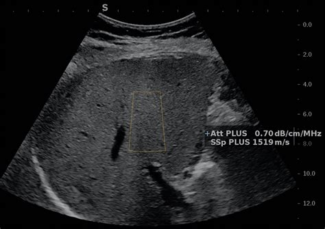 Cpt Code For Liver Ultrasound at Isla Lampungmeiua blog