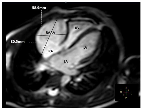 A Gigantic Congenital Right Atrial Appendage Aneurysm in an Infant: Ten ...
