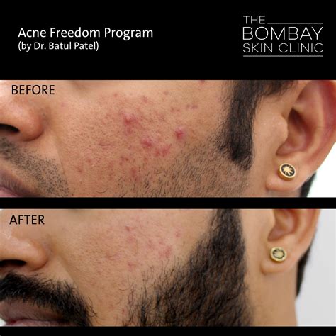 Acne Scar Treatment in Mumbai | The Bombay Skin Clinic