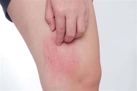 Why Do I Get Pimples on My Inner Thighs? | Be Young-aholic Blog