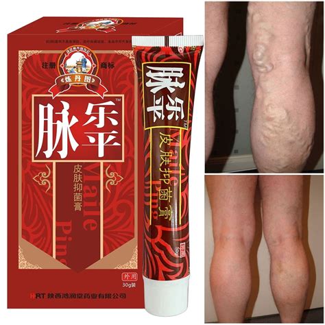 Buy Varicose Vein Treatment,Varicose Veins Cream suitable for Phlebitis ...