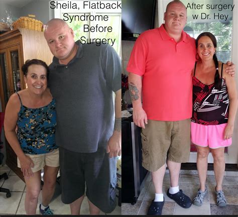 Flat Back Syndrome and Spondylolisthesis - can I ever stand up straight ...