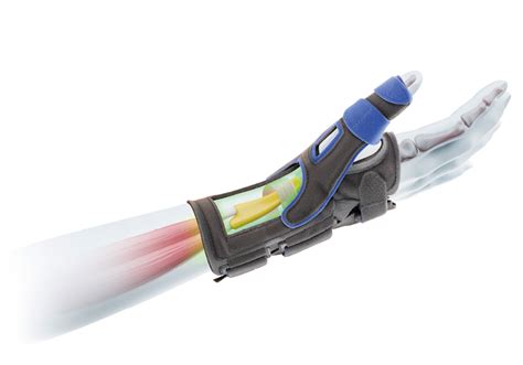 Tendovaginitis stenosans de Quervain - Bort