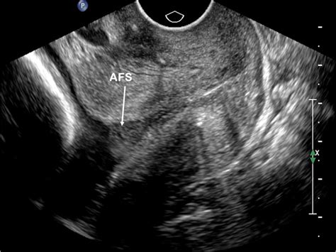 Short Cervix In Spanish at Nancy Hickman blog