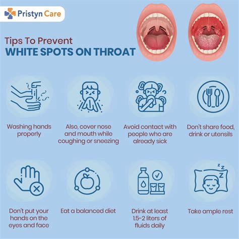 White Drainage Patch In Throat Throat Lump: 7 Reasons To Worry | ENT
