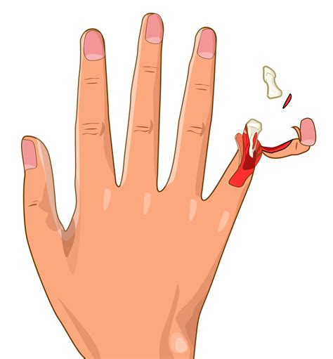 File:Finger avulsion injury svg hariadhi.svg - Wikimedia Commons