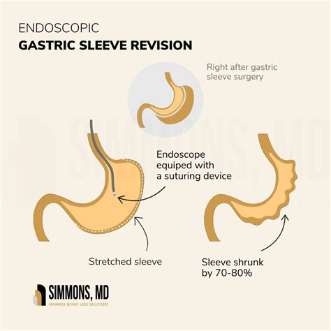 How Can Endoscopic Suturing Be Used for Bariatric Revision?